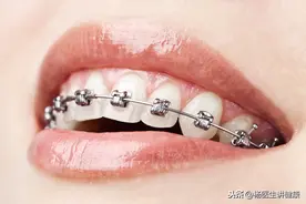 47岁戴牙套的尴尬图片