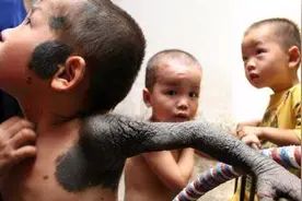 广州7岁男孩被砍事件后续：手术成功，断肢接活可能性较大视频封面