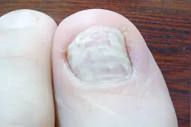 脚趾甲有横纹凹凸不平，不仅仅是真菌感染，或是这些原因视频封面