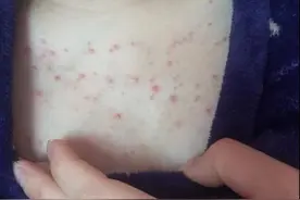 孕妈脖子胸前长满小红疙瘩，吓死人！难道是激素在作怪？图片