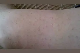 艾滋病皮疹与普通皮疹有什么不一样？