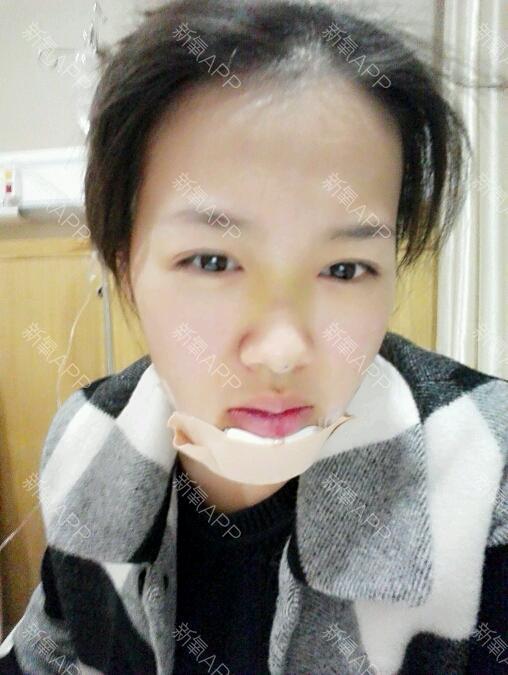 假体丰下巴,24天效果这样了