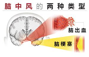 鍙堝埌鍐锛岃剳鍑鸿楂樺彂浜嗭紝浣犵煡閬撳浣曢闃插悧锛? onerror=