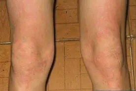 皮疹或是艾滋病前期症状图片