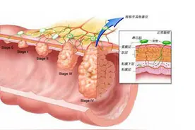 肛肠科检查为什么总要用手指摸肛门？肛瘘手术后还会复发吗？图片