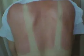 夏季皮肤病攻略（物理因素篇）图片