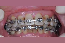 戴了钢牙想偷懒？摘下牙套悔断肠！图片