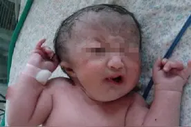 一位宝妈的育儿痛楚：宝宝咋一出生就患上了小儿歪嘴哭综合症图片