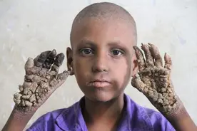 7岁男孩患怪病，手脚长“树枝”状肉瘤图片