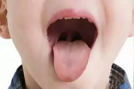 宝宝舌头上有一块没有舌苔是怎么回事？图片