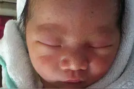 被推出产房后看到宝宝满脸胎毒，我后悔万分！图片