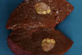 乙肝患者请坚决戒烟图片