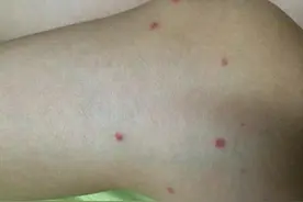 老年人手臂长红点，是过敏性紫癜吗？这个病能根治吗？图片