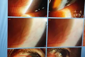 福建男子视力降到0.3，竟是因眼里长了一片肉！此病常被误以为是白内障图片