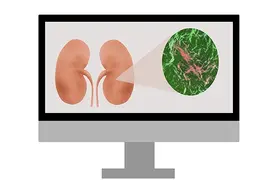 肾病进入终末期，只能透析和换肾？哪种疗法更好？医生为您讲清图片