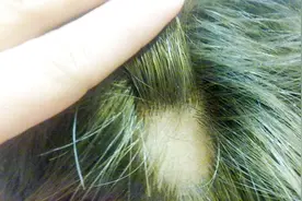 头发总是一大块一大块的脱落，是怎么回事，该怎么治疗？视频封面