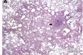 有关肺部微浸润腺癌(MIA)系统性讲解图片