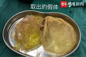 女子30年前隆胸如今假体破裂！外形像“果冻”…图片