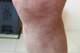 网状青斑，不会是什么不好的迹象吧？图片