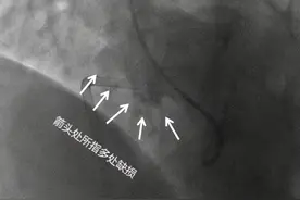 心脏上有5个洞！孕妇蒙了：我怎么能安稳活这么多年？图片