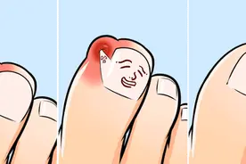 甲沟炎又疼又难治，愁！教你3招解放双脚图片