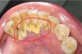 “牙结石”可以自己抠掉吗？教你一招，牙缝里的脏东西或能轻松掉图片
