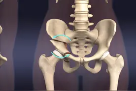 不想做人工髋关节置换，保髋手术能撑几年？图片