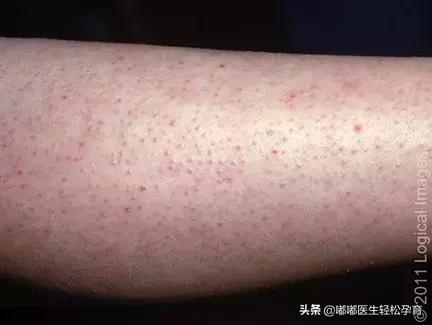 温度高对毛周角化