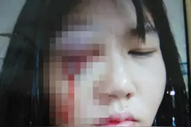 女子长期遭家暴，回娘家被丈夫拉到墓地殴打致左眼球破裂，母亲至今没接到对方一个电话图片