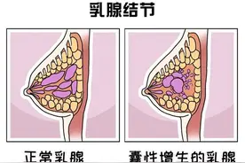 乳房结节切除，看似一劳永逸的手术，实则是将患者“画地为牢”图片