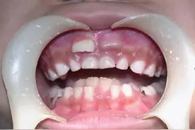 孩子出现“双排牙”，到底是谁的过错？图片