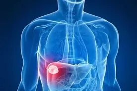 肝癌介入治疗，副作用大，很痛苦？这样做，可减轻痛苦，提升疗效图片