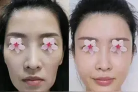 怎么填充太阳穴才能避免脸变大，有太阳穴凹陷的人来看看图片