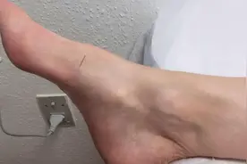 大腿内侧腹股沟痛，与冲脉的关系图片