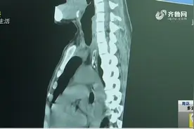 女子吃肉后胸口疼痛？到医院一检查，医生：“这得要做手术了”视频封面