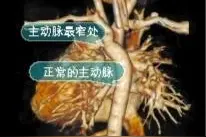 1小时35分钟手术 严重先心病患儿重获新生图片