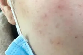 救命！戴口罩又化妆真的会烂脸图片