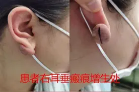 耳洞闭了又打，女子耳垂后增生出圆形肉疙瘩图片