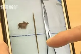 酒后误吞牙签扎入肝脏不当回事 医生天天电话劝他手术图片