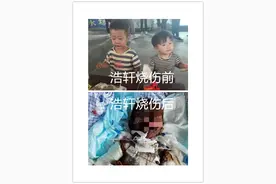重度烧伤的6岁男孩挺住！我们正不顾一切奔向你图片