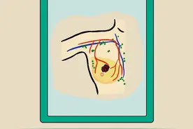 乳房有小硬块，就是乳腺癌吗？图片