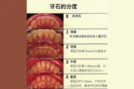 每天都认真刷牙 怎么还是长了牙结石？图片