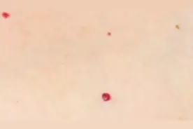 皮肤偶尔瘙痒、出现红点很多人不当回事，有可能是这些疾病的征兆图片