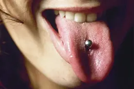 长沙16岁女孩打上“舌钉”后不适，医生：对健康百害无一利图片