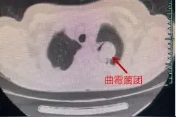肺发霉？！杭州女子反复咳嗽10多年，医生从肺里“挖”出“臭鸡蛋”图片