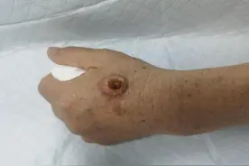 药膏反复刺激，70岁奶奶手上的小肿物恶化成癌图片