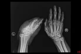 神奇！断掌离体缺血超过24小时 四川省医院专家6小时手术再植成功图片