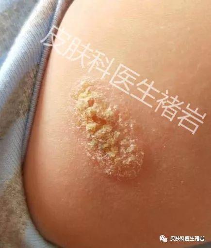 鸡皮疙瘩一块一块红肿