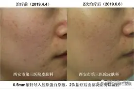 【微针】“滚”出来的无暇素颜美肌图片