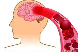 突然手麻脚麻，是血管堵塞吗？罪魁祸首离不开这8个原因，快对照看看图片